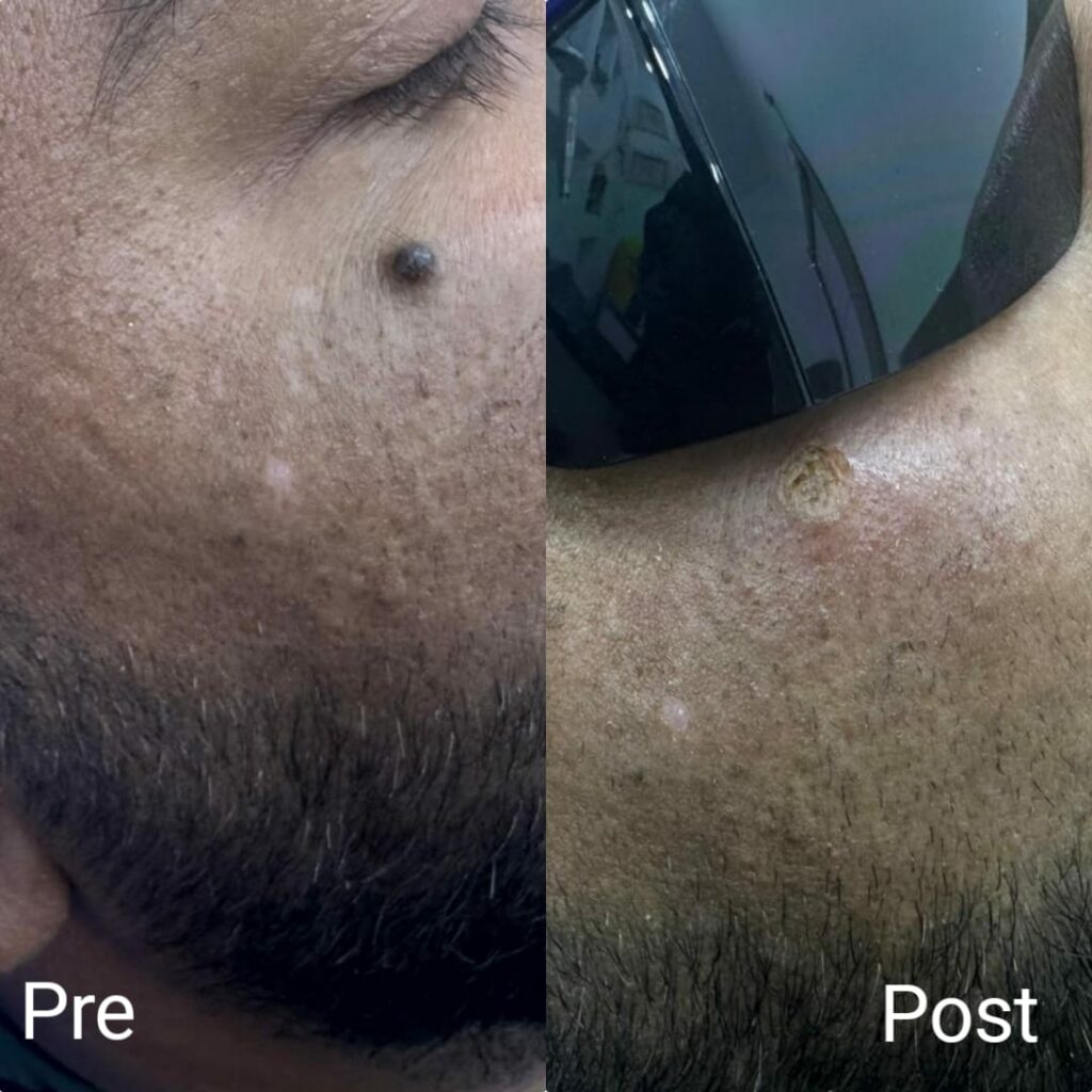 Laser removal of excess skin around the eye